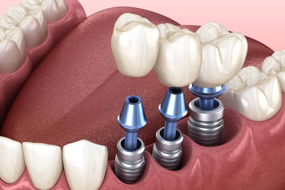 Dental Implants Pico Rivera CA&nbsp;