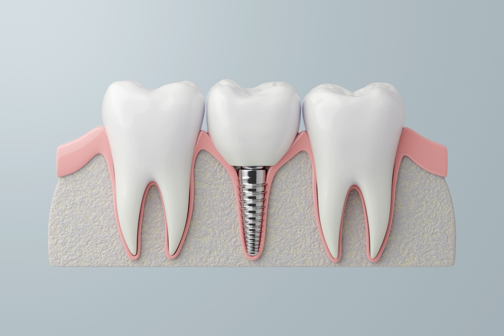Dental Implants