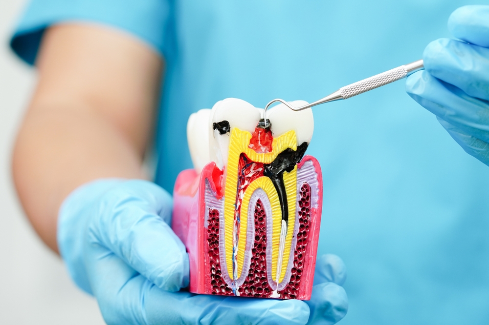 Understanding Root Canal Treatment