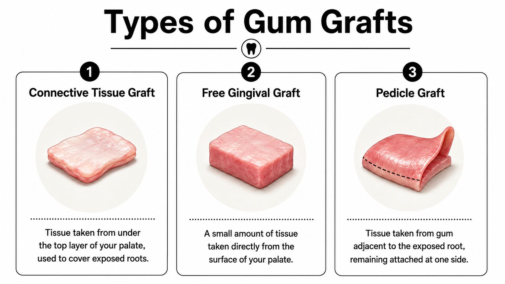 An infographic illustrating three common types of gum grafts: connective tissue, free gingival, and pedicle graft.